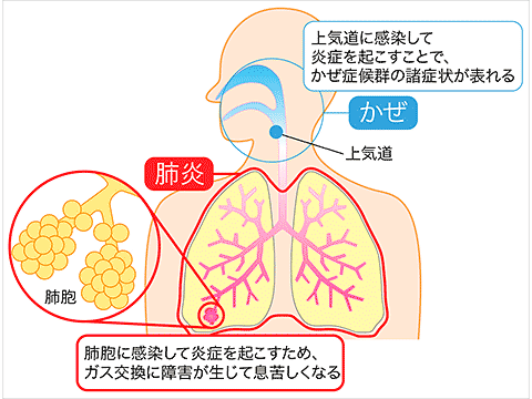 肺炎と風邪